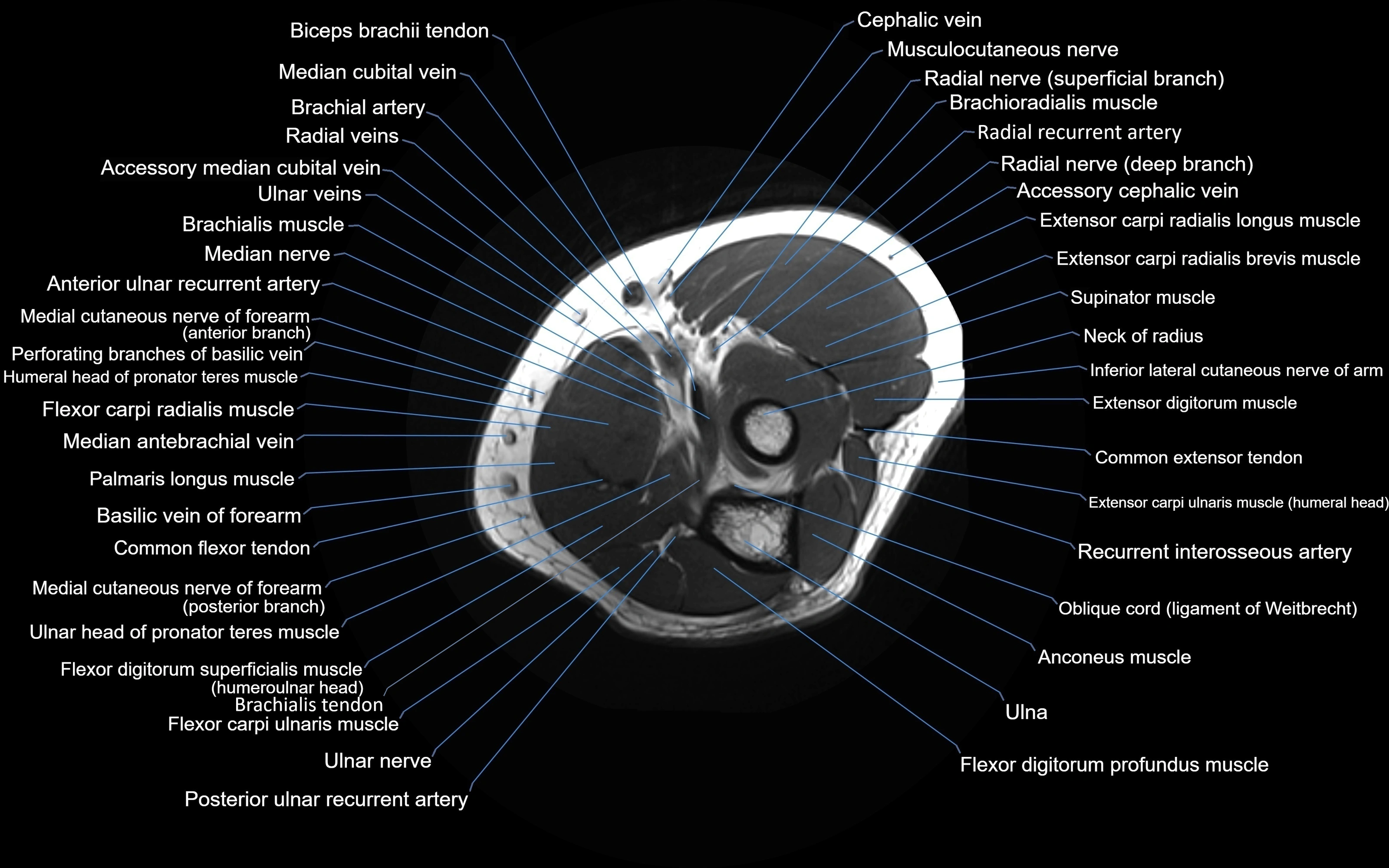 MRI elbow axial cross sectional anatomy 3T  radiology  image-img-00001-00021.webp